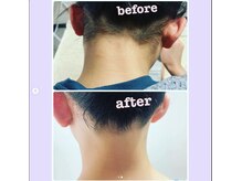 サンテ(Sante)/襟足脱毛ビフォーアフター