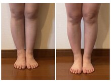 うつくし痩身 美サロン ゼットワン(Z-ONE)/メディセル1回　before　after