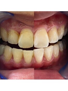 ホワイトニングショップ 福岡姪浜店/【ビフォーアフター】美白