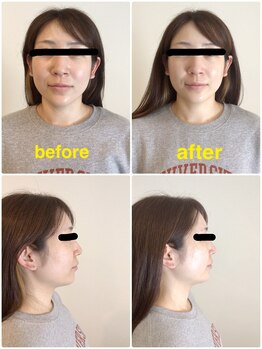 ビコツアコ(美骨Aco)/小顔メニュー登場（造形エステ）