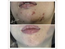 ミューベル(MYubelle)/ニキビ毛穴ケア　水光ピーリング