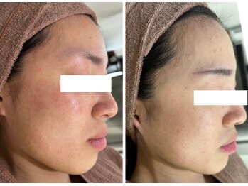 ホワイトアクア 四日市店(WHITE AQUA)/ニキビケア/四日市ハーブ