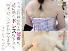 ソワンドビジュー(soin de bijew)/二の腕＆背中に、インディバ