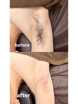 エフ ワクシングブティック(efu.WaxingBoutique)/わき¥3,000