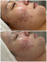 エーエフビューティーエステ(AF Beauty Esthetic)/ニキビ肌改善