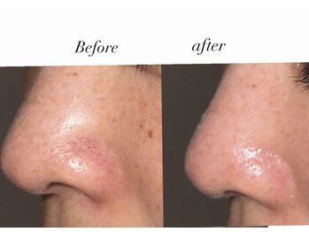 リファラ 光の森店(REFALA)/毛穴・ニキビケア専門REFALA