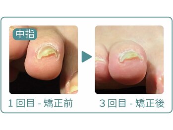 巻き爪研究所 表参道院/「手」や「足の親指以外」もOK