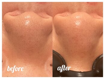 チル(chill)/毛穴洗浄するならここ！