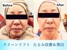 【小顔・タルミ】クイーンリフト（タルミ改善+幹細胞導入) 60分　¥6300→