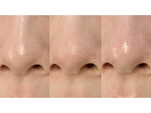 エミリー 守山(EMILY)/【症例写真】毛穴洗浄 (6)