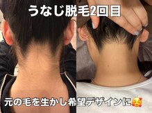 リエル(RIEL)/【うなじ脱毛】