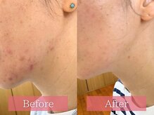 フローラ(FLORA)/フェイシャルエステ