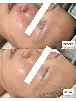 ルアラナ(Lualana)/初回から２か月の変化