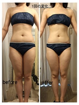 リープ(Lieb)/ボディ　ラジオ波ラジオスティム