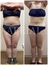 エアリアル 玉名店/脂肪冷却でマイナス17キロ！