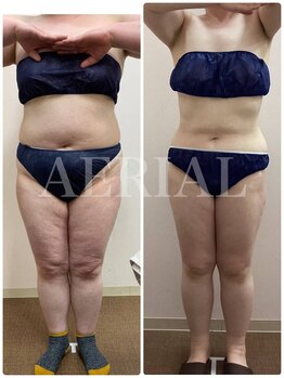 エアリアル 玉名店/脂肪冷却でマイナス17キロ!