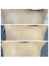 レミリー(Lemiry)/ハーブピーリング