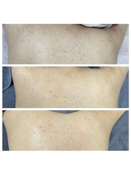 レミリー(Lemiry)/ハーブピーリング