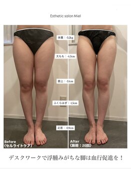 ミエル 恵比寿店(Miel)/セル脂肪ケア