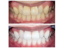 1ヶ月集中コースでキレイな白い歯へ/福山市ホワイトニング