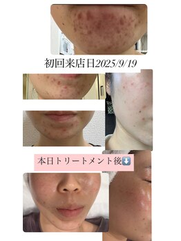 メゾン カルム 天文館店(MAISON CALME)/肌質改善　約半年での改善