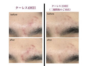 マーレ(Mare)/繰り返すニキビ改善