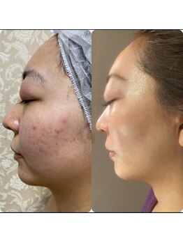 リアンボーテ(Lien Beaute)/ホワイトハーブピーリング/4回