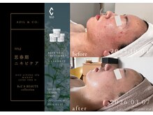 オーヴォ リビングスパ アネックス マノン(OVO LIVING SPA annex MANON)/【施術事例】思春期ニキビケア