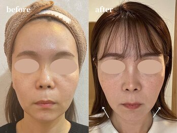 クレールアンジュ(ClairAnge)/小顔になりたい方