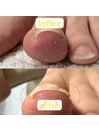 巻き爪ケアの変化