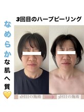 ブルーシー(BLUESEA)/【RHR】幹細胞ハーブピーリング