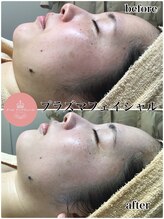 メールアンテリュール 神楽坂店/肌改善・小顔効果のフェイシャル