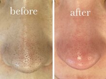 オゾンレメディ(O3remedy)/毛穴洗浄