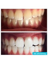 NA ホワイトニング 川崎溝の口店/ホワイトニング/川崎/溝の口