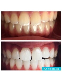 NA ホワイトニング 川崎溝の口店/ホワイトニング/川崎/溝の口