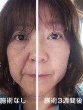 チュベルフェ(tu belle fe)/ギノーVAR