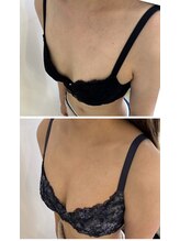 アンドモア(&more)/バストアップ症例