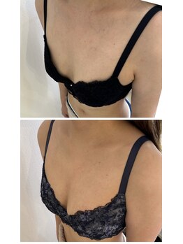 アンドモア(&more)/バストアップ症例