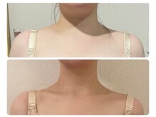 モナンジュ(ramonange)/デコルテbefore after