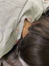 ヒューマン鍼灸接骨院/頸肩コリにオススメ