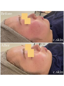 シースキン 盛岡駅前店(c.skin)/お客様ビフォーアフター♪