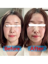 つくし鍼灸院/電気美容鍼ビフォーアフター