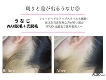 アルゴ 吹田千里山駅前店(ALGO)/ALGO式WAX脱毛＋光脱毛（1回）