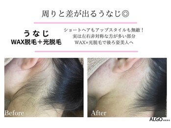 アルゴ 吹田千里山駅前店(ALGO)/ALGO式WAX脱毛+光脱毛(1回)
