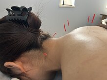 サンゴ(sango)/カラダの鍼