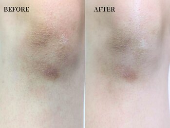 サンビ(SANBI)/膝の黒ずみにも効果的