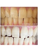 ホワイトニングルーム 横浜店(Whitening Room)/ホワイトニング/横浜
