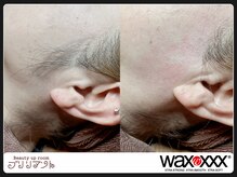 ブリリアント/もみあげwax脱毛