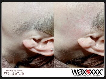 ブリリアント/もみあげwax脱毛