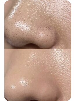 シェリ フルール(Cheri Fleur)の写真/毛穴の黒ずみ・皮脂づまりもスッキリ！産毛ケアで、自信の持てるツルツル肌をあなたに◎